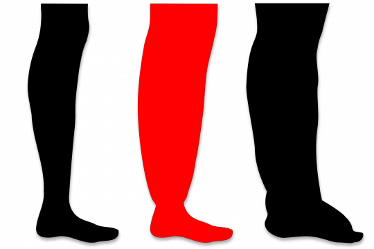 Lipedema and/or lymphedema?