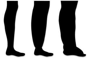 Lipedema or lymphedema?